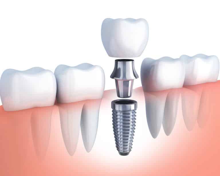Which Dental Insurance Covers Implants